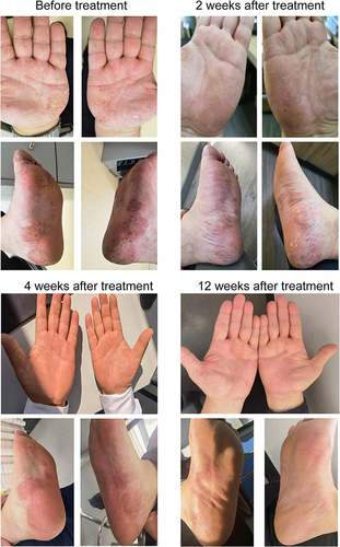 Figure 1 Clinical images of patient 1 at 0, 2, 4, and 12 weeks after tofacitinib treatment.