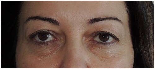 Figure 1. Preoperative aspect of the patient with dermatochalasis at upper eyelids and fat and skin excess at lower lids.