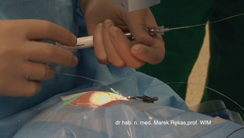 Figure 1. A surgeon using an iTrack microcatheter during canaloplasty procedure.
