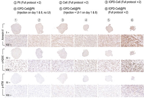 Figure 9. Cell damage and death in GBM tumors at the end of therapy, as shown by IHC staining of γH2AX, p-ATM (markers of DNA damage) and annexin-V (marker of apoptosis). therapy protocol is shown in Figure 8(A).