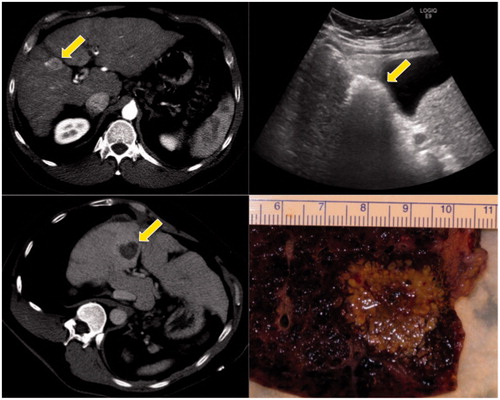 Figure 3. Clinical example of microwave ablation in a 57-year-old male with hepatocellular carcinoma and cirrhosis. The initial tumour was 2.6 cm on contrast computed tomography (CT) (upper left, see arrow). Intra-procedural ultrasound shows water vaporisation and bubbles highlight the zone of ablation (upper right). Post-ablation contrast CT shows the non-enhancing zone of ablation (lower left). This patient went on to transplant within a few days, and the post-ablation explant shows the ablated tumour plus a surrounding tissue margin (lower right).