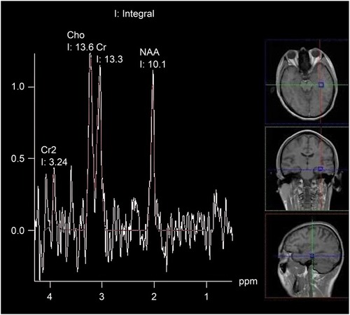 Figure 2 MR spectroscopic images of the post-stroke depression group. The MR spectroscopy image is shown on the left side. The right indicates the location of the left temporal lobe on MR images.