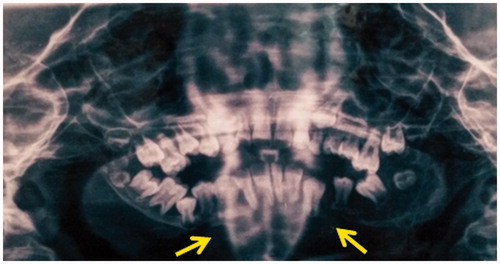 Figure 1. Mandibular osteolysis.