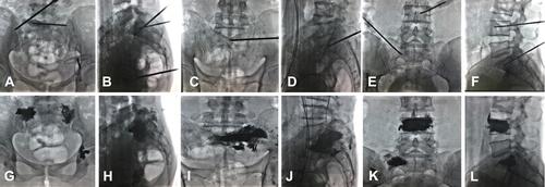 Figure 1 Anteroposterior and lateral radiographs obtained during and after percutaneous sacroplasty (PSP) procedure shows the different puncture approaches towards the target lesions at the sacral ala, including the posterior approach (A, B, G, and H), transiliac approach (C, D, I, and J), and anterior-oblique approach (E, F, K, and L).