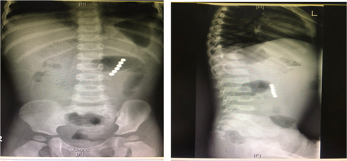 Figure 3 Supine and decubitus views of abdominal X-ray of the child showed multiple magnets in the upper portion of small intestines.