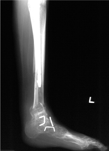 Figure 3 Radiograph after removal of the external fixator, showing pantalar arthrodesis of the foot deformity and supramalleloar osteotomy for correction of residual equinus deformity.