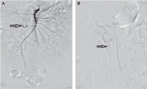 Figure 2 Mesenteric arterial angiography.