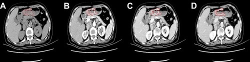 Figure 1 NC-CT and CE-CT scans of GACs.Notes: CT images in the non-contrast phase (A), arterial phase (B), portal venous phase (C), and delayed phase (D) showed a thickened gastric wall. The thickened gastric wall was targeted as the ROI. The ROI was manually drawn along the margin of the lesion (red line).