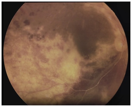 Figure 1 The right eye showed yellowish-white retinitis surrounding the inferior and temporal aspect of the macula and along the superior vascular arcades, angiostenosis of the inferior vascular arcades, and retinal hemorrhage.