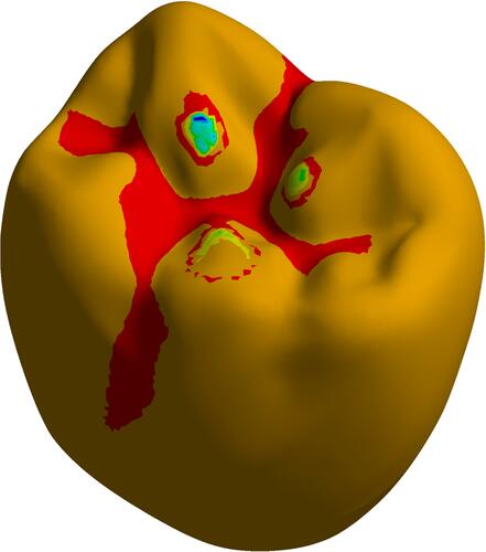 Figure 12 Fractographic of fractured crowns.