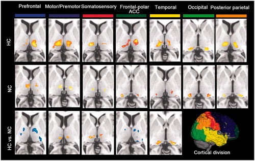 Figure 3. Functional connectivity mapping of the thalamus for each cortical ROI in each thermal condition and the paired comparison. The most prominent differences between both conditions showed decreased frontal-thalamic (including cortical fronto-polar/ACC and prefrontal areas), increased sensorimotor-thalamic (including somatosensory and motor/premotor areas) and temporal-thalamic connectivity during hyperthermia.