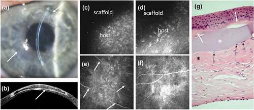 Figure 4. Postoperative assessment of stromal regeneration following biosynthetic corneal implantation into keratoconus patients by anterior lamellar keratoplasty, three years postoperatively (A – F) and four years postoperatively in one patient (G). (a) The anterior lamellar scaffold remained transparent, with border region visible in the slit lamp (border indicated by arrows). (b) Optical coherence tomography reveals the intact scaffold with increased stromal density and reflectivity at implant-to-host interfaces (arrow). (c, d) By in vivo confocal microscopy, stromal cells from the host have not migrated to occupy the implanted scaffold (dark, transparent region). (e, f) Subbasal nerves anterior to the scaffold have partially regenerated (arrows). (g) Hematoxylin and eosin stained section from an excised corneal button indicates an intact scaffold (white asterisk) that remains acellular. Host stromal cells (black arrows) are present at the scaffold-to-host lamellar interface, within a region of denser, more compacted collagen (black asterisk) indicated by stronger eosinophilic staining. Stromal fibroblasts also migrated anteriorly to the implant under the epithelium and deposited a layer of denser collagen, consistent with the light-scattering scar tissue (white arrows) also observed anteriorly in the subbasal plexus (F). Images (C – F) are 400 x 400 µm.