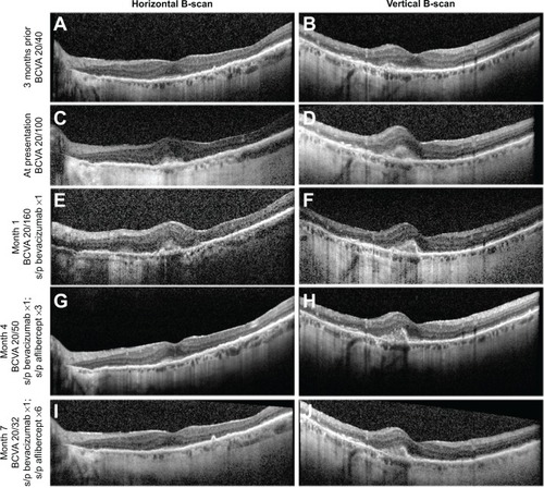 Figure 2 Horizontal (left column) and vertical (right column) individual B-scan images from indicated time points.