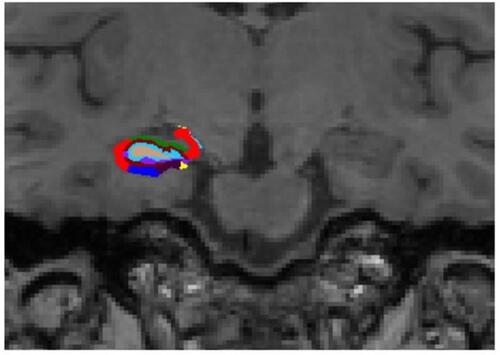 Figure 2 Representative subdivision of the hippocampal subfields. The mask of each region was overlapped on the coronal T1-weighted images. Color classification: parasubiculum = yellow; presubiculum = black; subiculum = blue; Cornu Ammonis (CA)1 = red; CA3 = dark green; CA4 = brown; granule cell layer of dentate gyrus (GC-DG) = sky blue; hippocampus-amygdala-transition-area (HATA) = green; fimbria = purple; molecular layer hippocampus (HP) = dark brown; hippocampal fissure = dark purple; hippocampal tail = gray.