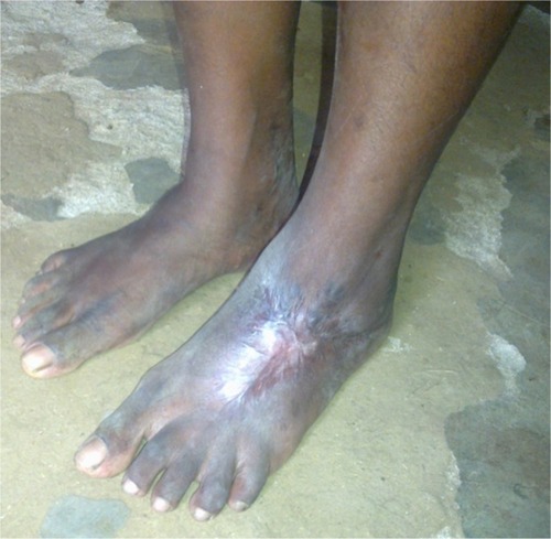 Figure 2 Soft tissue contracture of the left foot following snakebite.