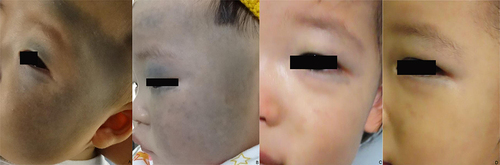 Figure 2 Treatment process for type III and IV nevus of Ota in infants. (A) Before treatment; (B) 6 months after the first treatment; (C) 6 months after the fourth treatment; (D) 2 years after the 4th treatment.