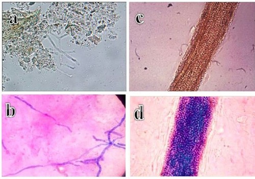 Figure 1 Microscope images of: (A) translucent, non-pigmented, septate hyaline hyphae of Trichophyton rubrum (blue arrow) in a nail sample (10% KOH stain, ×400). (B) Endothrix hair invasion, with translucent and non-pigmented spores of Trichophyton violaceum (10% KOH stain, ×100). (C) Bluish, narrow septate hyphae of Trichophyton rubrum against a pink background in a nail sample (Chicago sky blue stain, ×400). (D) Endothrix hair invasion with blue spores of Trichophyton violaceum (Chicago sky blue stain, ×100).