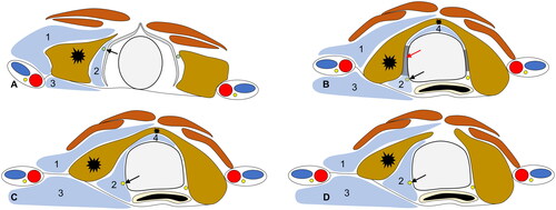 Figure 2. Schematic drawing of the main structures around the thyroid at different cervical levels and hydrodissected fascial spaces. (A) Hydrodissected spaces at the C4-5 level. The infrahyoid muscles could be protected by hydrodissecting the ACS (1). The SLN (green circle and arrowhead) could be protected by the hydrodissected VS (2). The carotid sheath and surrounding muscles could be protected by the POTS (3), isolating fluid. (B) Hydrodissected spaces at the C6 level. The RLN (yellow circle and black arrowhead) could be protected by hydrodissected VS. Hydrodissection was restricted by the suspensory ligament of the thyroid gland (red arrowhead). The trachea could be protected by the hydrodissected VS. (C) The hydrodissected spaces at the C7 level. RLN (yellow circle, black arrowhead) could be protected by hydrodissected VS. (D) Hydrodissected spaces below the C7 level. The RLN (yellow circle and black arrowhead) could be protected by the hydrodissected VS.