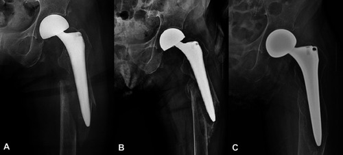 Figure 4 A 77-year-old woman was admitted to the hospital with a transfer fracture in the femur shaft. (A) On simple radiography, a fracture of the left femur around the femur stem with angulation and shortening was observed. (B) A 12-week radiograph after the sponge cast was applied. (C) A 20-week radiograph after sponge casting, which shows the union of the fracture.