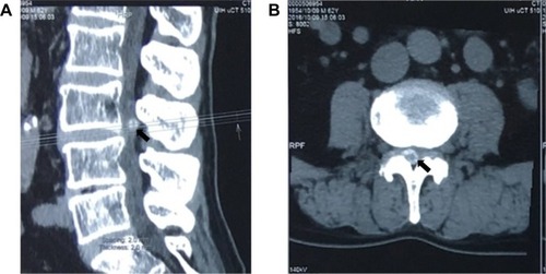 Figure 3 Computed tomography (CT) images of the lower spine.
