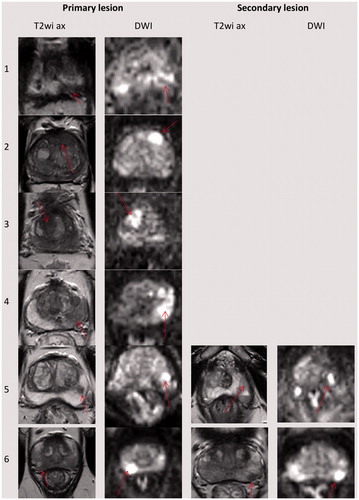 Figure 1. Location of the targeted lesions on baseline MRI. Note the red arrow pointing to the lesion on each image sequence. The first four patients had only one lesion, the last two patients also had a secondary lesion. Every lesion involved MRI-TBx-proven histologically significant PCa. On treatment planning, lesions were contoured with 5 mm of overlap when feasible, except near the NVB where a posterolateral 3 mm safety margin was ethically required for this treat-and-resect study, regardless of lesion coverage.