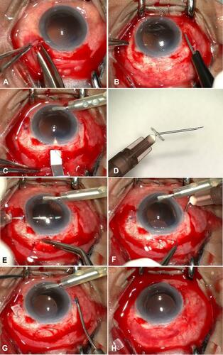 Figure 1 After limited conjunctival peritomy (A) 2 diagonally opposite scleral tunnels are fashioned and opened to the vitreous cavity by sclerotomy (B). A superior sclero-corneal incision is made (C). A bent hypodermic needle (D) receives the leading haptic in the anterior chamber (E) and the externalized haptic is sleeved by a silicone element for haptic stabilisation. The externalised (F) haptics are held at a measured distance from the tip with forceps and pocketed into the scleral tunnel (G) to bend the tip. Lens centration ensured at the end of the procedure (H).