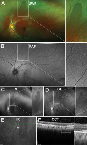 Figure 10. 29 year old Asian male with DWOP. (A) UWF imaging demonstrates irregular patches in the retinal periphery which show no alteration on (B) FAF but are visible on (C) red-free, less so on (D) green-free imaging. (E) Infrared imaging demonstrates DWOP as hyporeflective region and (F) peripheral OCT at the margin of the lesion highlights the alterations in reflectivity of the ellipsoid zone in the outer retina in DWOP. Abbreviations as in Figure 3.