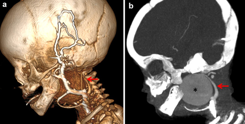 Figure 2 Sagittal volume-rendered three-dimensional (a) and maximum intensity projection (b) images demonstrating an aneurysm (asterisk) originating from the internal carotid artery (red arrow).