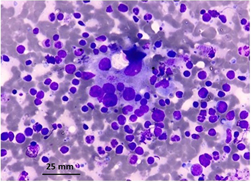 Figure 6 Plenty of lymphocytes with focal impingement of follicular epithelial cells (Giemsa, x400).