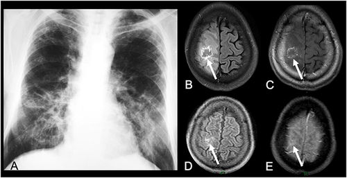 Figure 3 A 31-year-old woman presented with cough and seizures. (A) Chest radiograph revealed bilateral pulmonary consolidations, more conspicuous in the central areas (“butterfly wing” pattern). Brain MRI demonstrated a cortico-subcortical right frontal lesion, with predominantly hypointense signal on FLAIR (arrow in (B)), associated with peripheral irregular gadolinium-enhancement (arrow in (C)), and edema. Brain MRI performed 5 months after antifungal treatment showed significant reduction of the lesion and peripheral edema, on FLAIR and postcontrast T1-weighted imaging (arrows in (D and E), respectively).