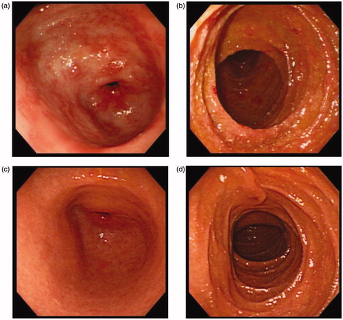 Figure 3. Results of endoscopic examinations before and after IL-6 inhibitor therapy. (a) Before tocilizumab therapy, the appearance of the mucosa in the antrum of the stomach was coarse with reddish and edematous changes. (b) Before tocilizumab therapy was initiated, the appearance of the mucosa in the second portion of the duodenum was coarse, nodular, irregular, edematous, and reddish. (c, d) After 18 months of tocilizumab therapy, no abnormality was observed in the antrum of the stomach or in the second potion of the duodenum (quoted from Okuda et al. [Citation6]).