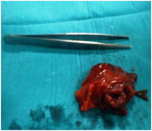 Figure 2 Surgically resected lesion, which was noted in the right parametrium measuring 6.5 × 5.5 cm.