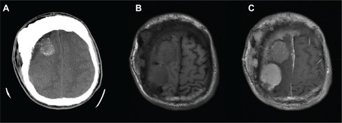 Figure 3 Axial view of brain computed tomography without contrast.