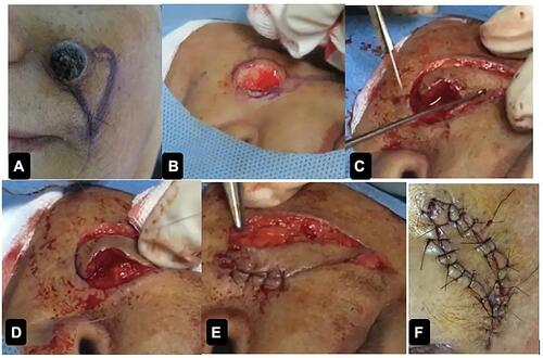 Figure 3 Excision and defect closure steps. (A) The tumor and skin marking for IPF; (B) Total excision of the tumor; (C) The initial step of IPF, making incision of secondary defect; (D) Advancing the flap to the primary defect; (E) Suturing the flap; (F) The final step of the IPF procedure.