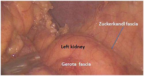 Figure 7. The posterior fascial layer of the kidney was named after Zuckerkland by Dimitri Gerota.