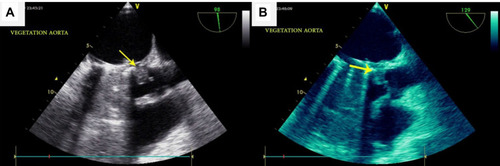 Figure 2 (A, B) Transesophageal echocardiography showed large vegetation (arrow) of aorta.