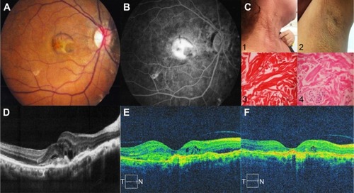 Figure 2 Case 6. Fifty-three-year-old female who complained of decreased visual acuity as chief complaint.