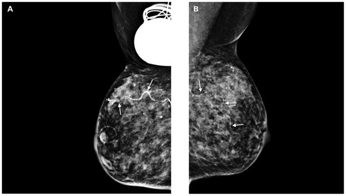 Figure 3 Bilateral mammogram showing benign arterial calcifications. (A) Right mediolateral oblique view shows arterial calcification (arrows) and (at top right of image) a pacemaker. (B) Left mediolateral oblique view shows arterial calcification (arrows).