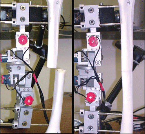 Figure 4. Bone alignment before and after projection-based fracture reduction of model A. Left: Before reduction (θr = 22.76°, dr = 29.28 mm); Right: After reduction (θr = 3.07°, dr = 1.41 mm).