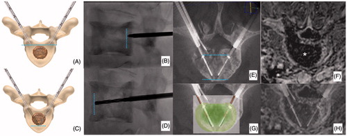 Figure 2. Bilateral double-probe approach performed with the “drill-kissing” technique. (A, B) The vertebral body is bilaterally accessed with 10–13 G bone trocars; the distal tips of the trocars are deployed just behind the posterior margin of the tumour; and the line connecting the tips of both trocars corresponds to the posterior margin of the ablation area. (C, D) Bone drilling is thereafter performed coaxially to create a channel to allocate the electrodes; the distal tip of the drills is advanced just anteriorly to the anterior margin of the tumour with a “drill-kissing” configuration; the line passing through the distal tips of the drills corresponds to the anterior border of the ablation area. (E) Final configuration of electrodes deployment with their distal tips spaced away 8–10 mm. (F) Axial T1-weighted CE-MRI sequence showing the size of the ablation area (*) roughly reproducing the shape of the vertebral body. (G) Reconstructed image showing the expected ablation area based on the configuration of electrodes deployment. (H) Reconstructed image showing the ablation area obtained at 24-h CE-MRI based on the configuration of electrodes deployment.