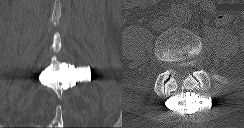 Figure 8 Representative CT scans of a fused segment.