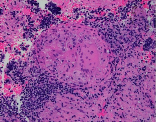 Figure 3 Lymph-node biopsy: non-caseating granuloma.