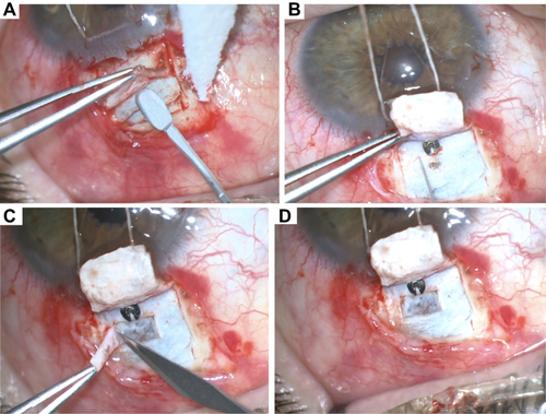 Figure 1 ExPRESS® modified technique. (A) creation of the superficial scleral flap 4×4 mm; (B) Insertion of implant into the AC after scleral tunelization with a 27G needle; (C and D) creation of the deeper scleral flap 1.5x2mm.