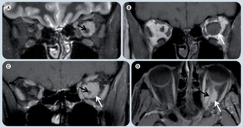 Figure 10. Optic nerve meningioma.(A) Coronal T2-weighted image (WI), (B) T1-WI, (C) T1-WI fat-suppressed postgadolinium, and (D) axial T1-WI fat-suppressed postgadolinium MRI at level of the optic nerves. An intraconal, left orbital well-defined oval tumor (white arrows), which is (A) T2 hyperintense and (B) isointense on T1-WI relative to the optic nerve is present and (C & D) has avid contrast enhancement. (D) The optic nerve (black arrow) is seen within the mass and does not enhance, giving the typical ‘tramtrack’ sign on axial image.
