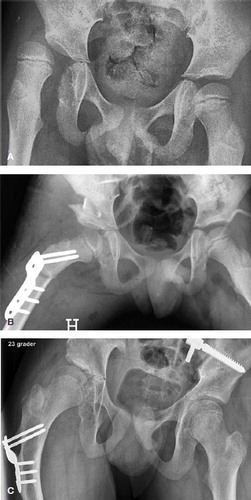 Figure 1. A. Preoperative radiograph of a boy, aged 7.0 years and GMFCS level V, with severe subluxation of his right hip (MP 67%). B. 1 day after femoral osteotomy (varus, derotation and shortening), pelvic osteotomy, and bilateral soft tissue releases, showing good femoral head coverage bilaterally. The cortical bone segment removed from femur has been used as autograft in the open wedge of the pelvic osteotomy. C. 7.4 years postoperatively, at an age of 14.4 years, showing satisfactory femoral head coverage bilaterally, MP 19% (right hip) and 0% (left hip)