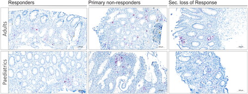 Figure 3. TNF mRNA ISH in adults and paediatric IBD colonic tissue. Examples of TNF mRNA ISH in the different response groups of adult and paediatric IBD patients. TNF mRNA expression (red stain) is shown in the lamina propria area. The examples suggest that, in adults, TNF expression is high in PNRs compared to responders and SLORs, moreover, in paediatric patients, a similar trend with high TNF expression in PNRs compared to responders and SLORs is noted. The examples also suggest that adults have higher TNF expression than paediatric patients. The TNF mRNA ISH signal was quantified using image analysis (see Figure 1).