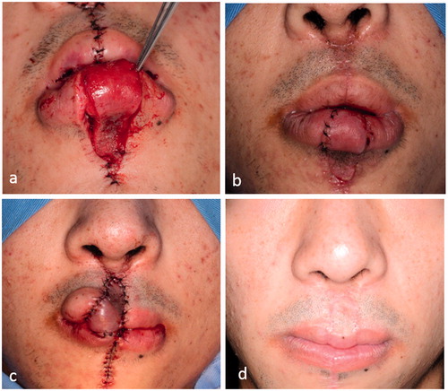 Figure 2. (a) Seven hours after returning the flap to the donor site, (b) 1 week after surgery, (c) re-transplantation of the lip switch flap and (d) 1 week after surgery.