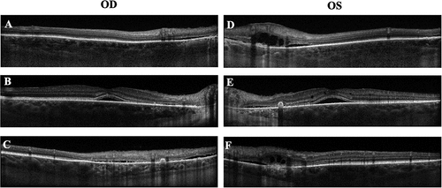 Figure 2. Macular OCT on initial presentation of Patient 1. A-C. OCT showed multifocal shallow subretinal fluid with multiple hyperreflective PEDs involving fovea and peripapillary region in the right eye. D-F. OCT showed multifocal shallow subretinal fluid with multiple hyperreflective PEDs involving fovea and peripapillary region with overlying intraretinal fluid in the left eye.