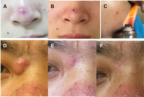 Figure 1 Patient 1: A furuncle on the nasal tip. (A) Lesion before fire needle therapy. (B) Lesion 2 days after fire needle therapy. (C) Fire needle therapy. Patient 4: A skin abscess on the right medial canthus. (D) Lesion before fire needle therapy. (E) Lesion 10 days after fire needle therapy. (F) Lesion after one year of fire needle therapy; no recurrence within one year.