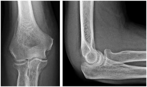 Figure 1. At presentation, soft tissue swelling but preserved articular cartilage and joint space.